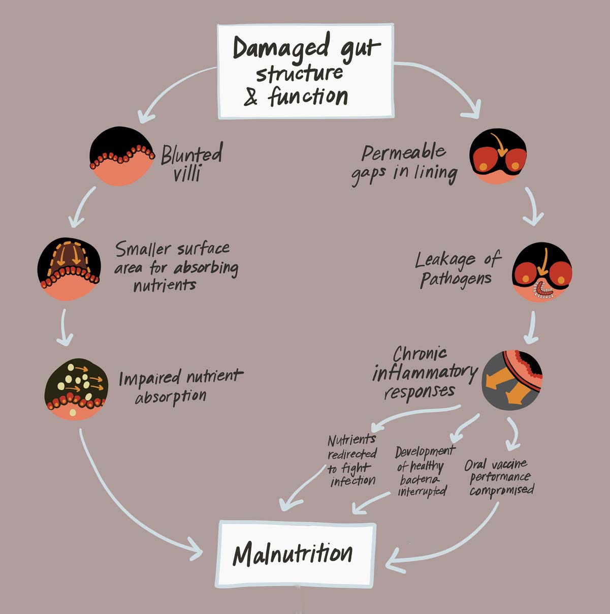 Flowchart illustrating damaged gut structure and function leading to malnutrition. It shows blunted villi, smaller surface area, impaired nutrient absorption, permeable gaps, pathogen leakage, and chronic inflammation, forming a continuous cycle.